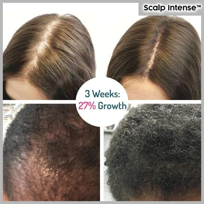 Scalp Intense™ - Hair Growth Serum - Gear Elevation